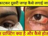CG” स्किन ग्राफ्टिंग से मरीज के पलक का सफल पुनर्निर्माण: युवक को नई दृष्टि और सामान्य जीवन की ओर लौटने का मिला अवसर’