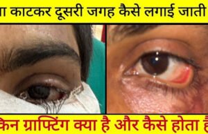 CG” स्किन ग्राफ्टिंग से मरीज के पलक का सफल पुनर्निर्माण: युवक को नई दृष्टि और सामान्य जीवन की ओर लौटने का मिला अवसर’